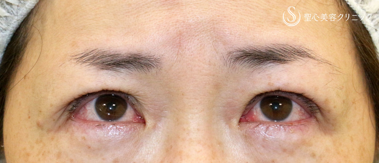 【40代女性・ハードコンタクトによる眼瞼下垂】切らない眼瞼下垂+α法（術直後） After 
