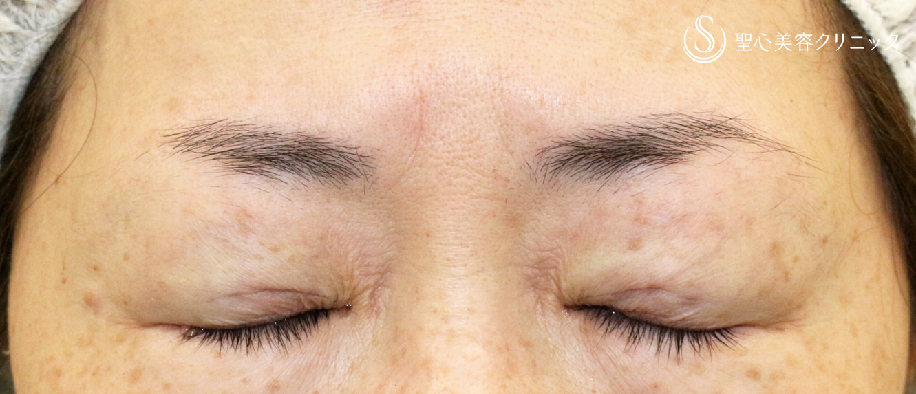 【40代女性・ハードコンタクトによる眼瞼下垂】切らない眼瞼下垂+α法（術直後） After 