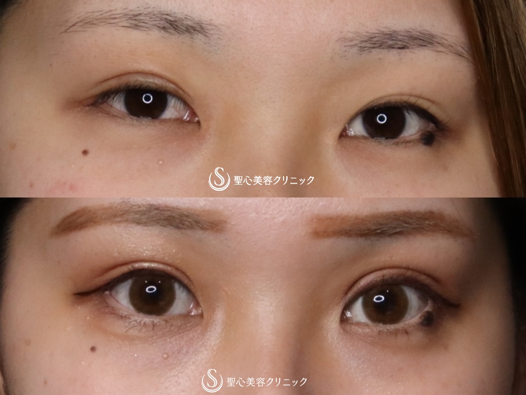 【20代女性・取れない綺麗な二重にしたい！】二重術（切開法）（術後1か月） After 