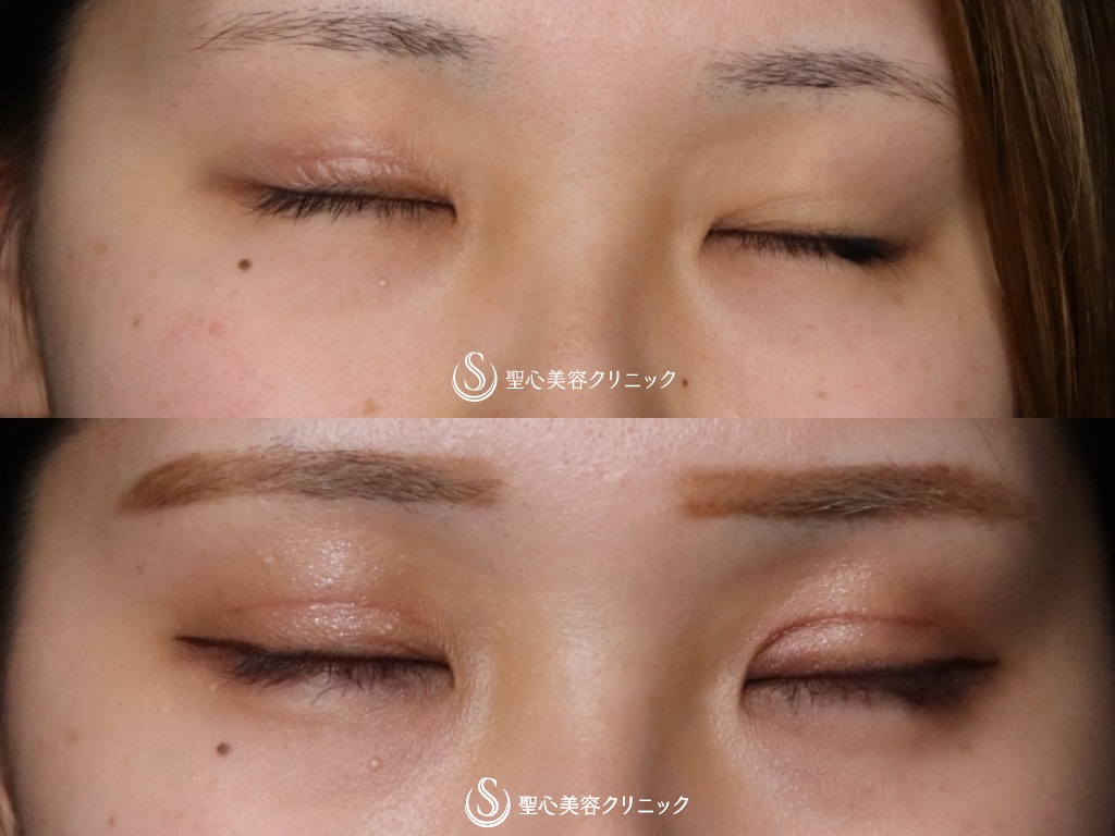 【20代女性・取れない綺麗な二重にしたい！】二重術（切開法）（術後1か月） After 