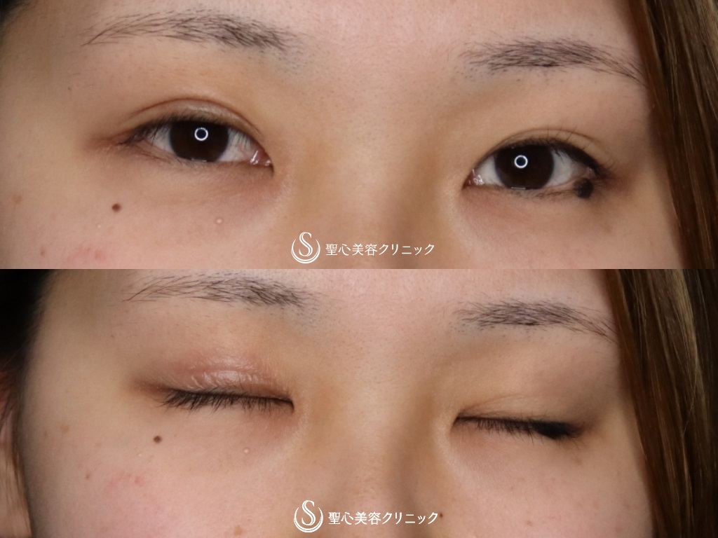 【20代女性・取れない綺麗な二重にしたい！】二重術（切開法）（術後1か月） Before 