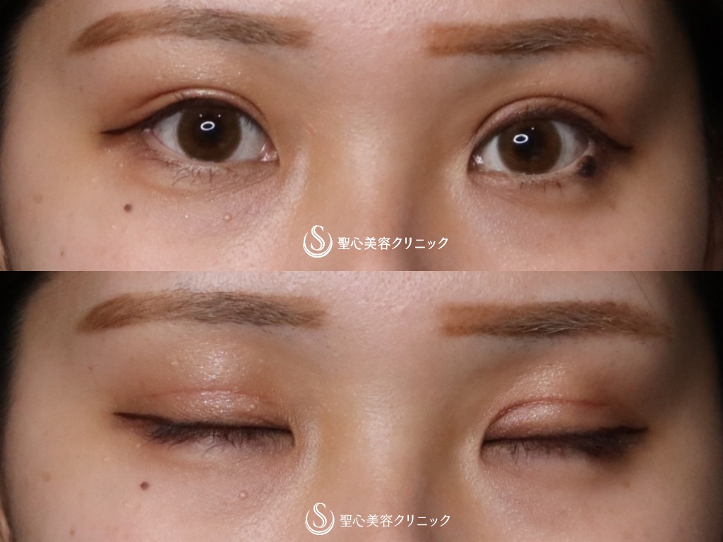 【20代女性・取れない綺麗な二重にしたい！】二重術（切開法）（術後1か月） After 