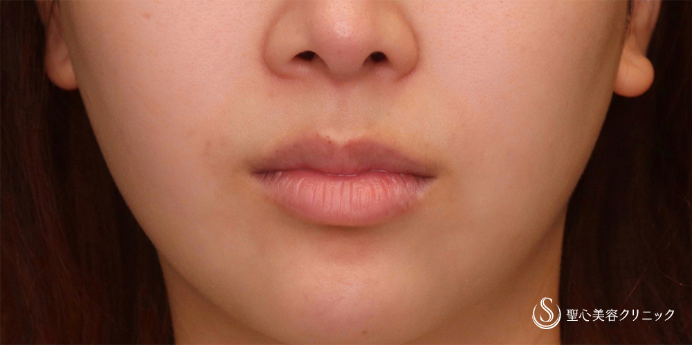 【20代女性・口角をナチュラルにあげて、より整えたい！！】プレミアム口角挙上術（術後2ヶ月） Before 