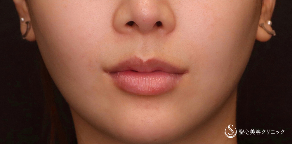 【20代女性・口角をナチュラルにあげて、より整えたい！！】プレミアム口角挙上術（術後2ヶ月） After 