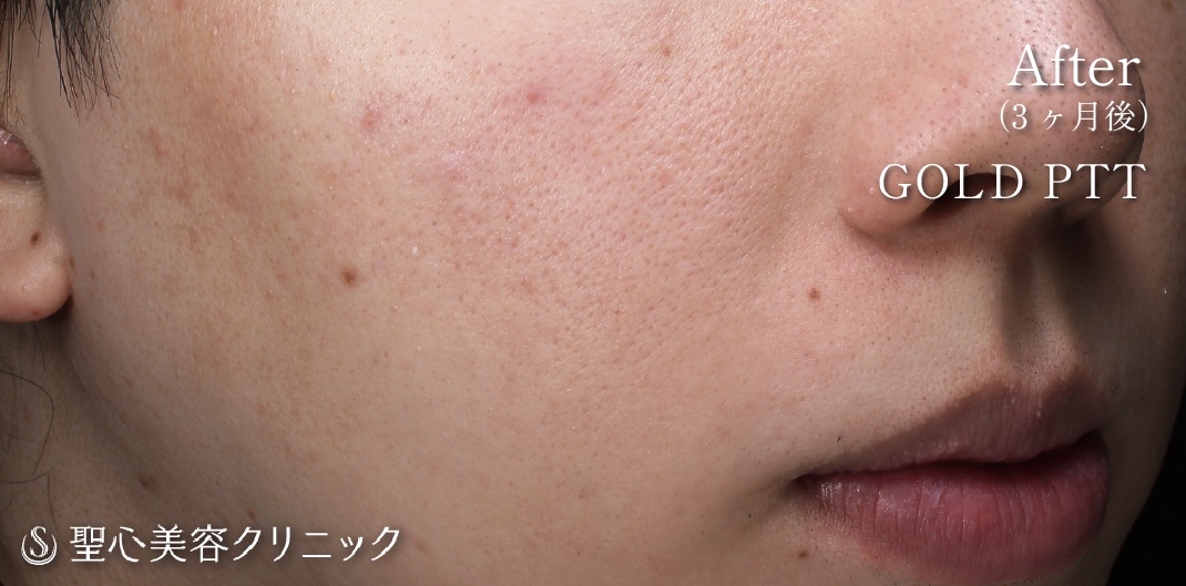 【20代男性・脂性肌】GOLD PTT（ゴールドPTT）（2回処置後） After 