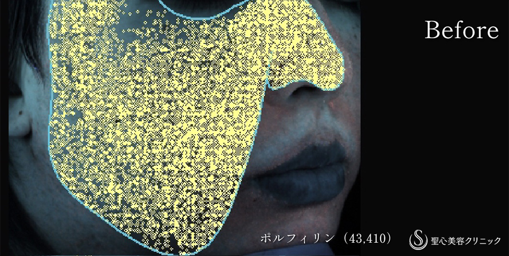 【20代男性・脂性肌】GOLD PTT（ゴールドPTT）（2回処置後） Before 