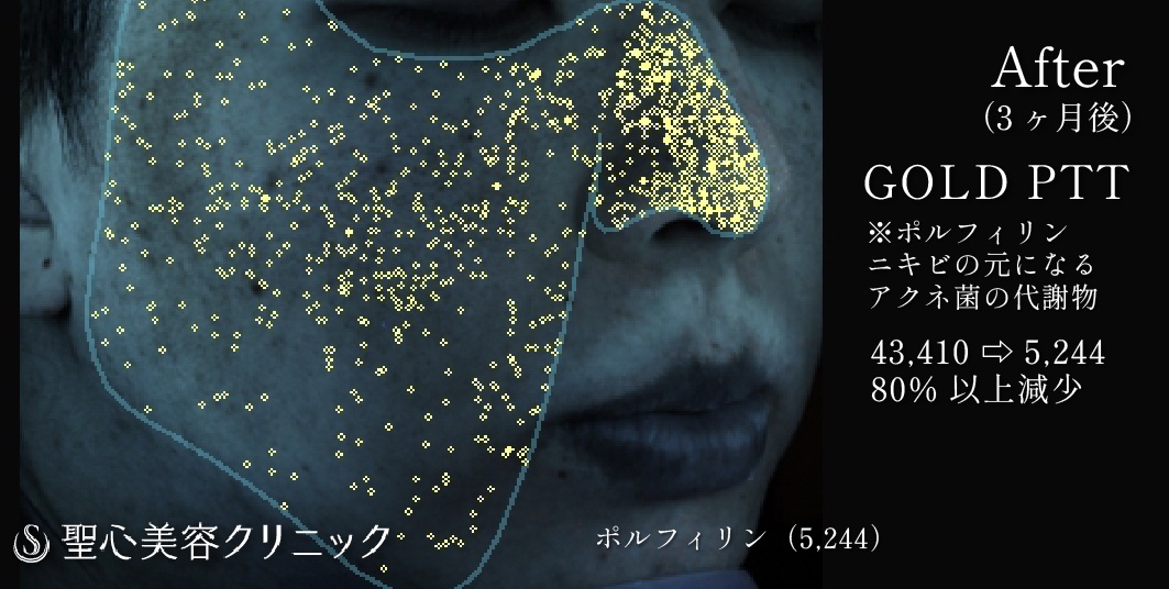 【20代男性・脂性肌】GOLD PTT（ゴールドPTT）（2回処置後） After 