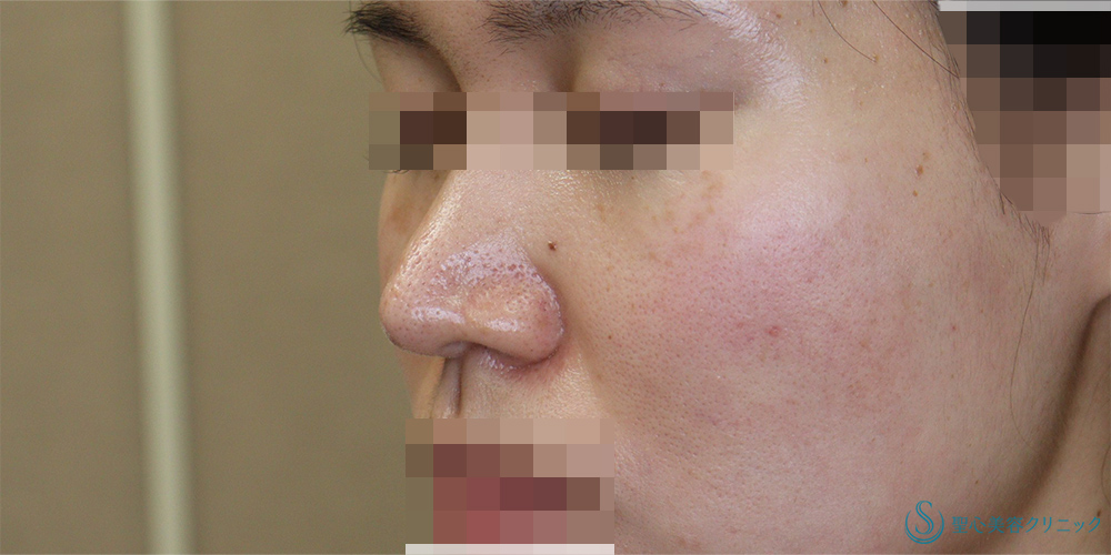 【20代女性・鼻先をより綺麗に】鼻尖縮小＋鼻尖形成(耳介軟骨移植)(術後4ヶ月) After 