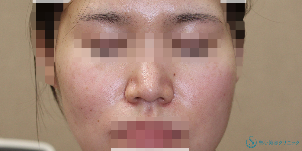 【20代女性・鼻先をより綺麗に】鼻尖縮小＋鼻尖形成(耳介軟骨移植)(術後4ヶ月) After 