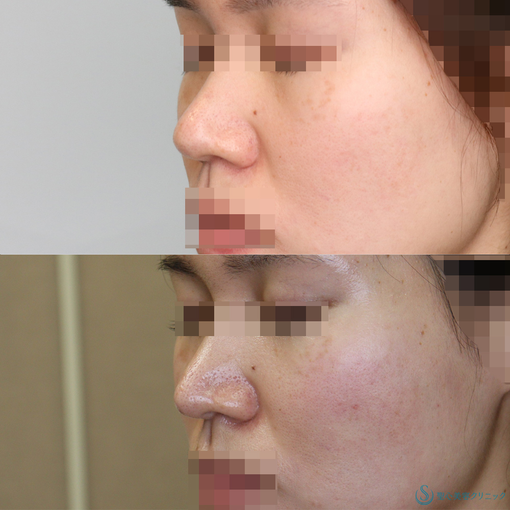 【20代女性・鼻先をより綺麗に】鼻尖縮小＋鼻尖形成(耳介軟骨移植)(術後4ヶ月) After 