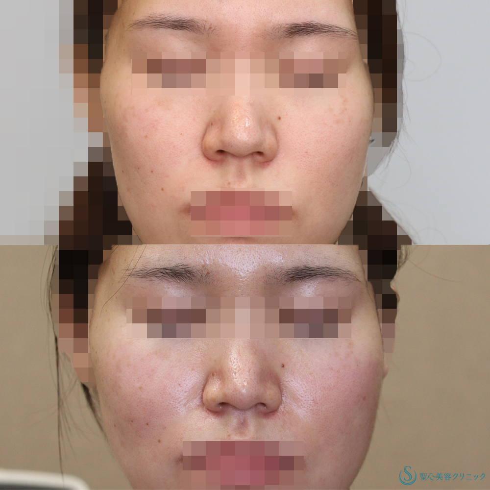 【20代女性・鼻先をより綺麗に】鼻尖縮小＋鼻尖形成(耳介軟骨移植)(術後4ヶ月) After 