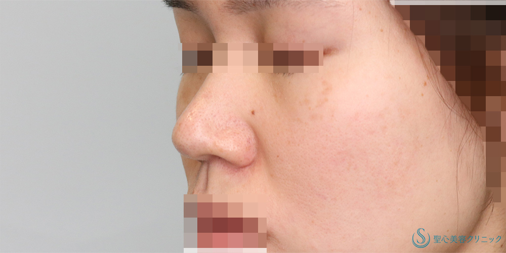【20代女性・鼻先をより綺麗に】鼻尖縮小＋鼻尖形成(耳介軟骨移植)(術後4ヶ月) Before 