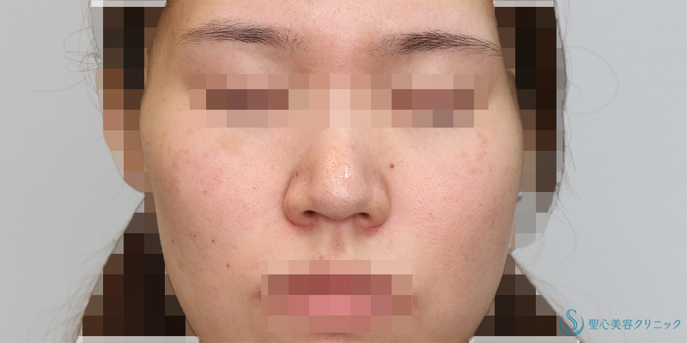 【20代女性・鼻先をより綺麗に】鼻尖縮小＋鼻尖形成(耳介軟骨移植)(術後4ヶ月) Before 