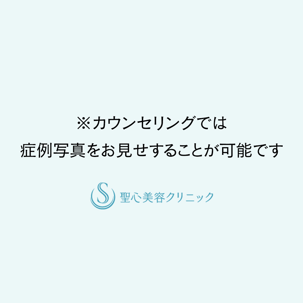 【20代女性・デリケートゾーンの黒ずみを改善】インティマレーザープロ（施術後1ヶ月） Before 