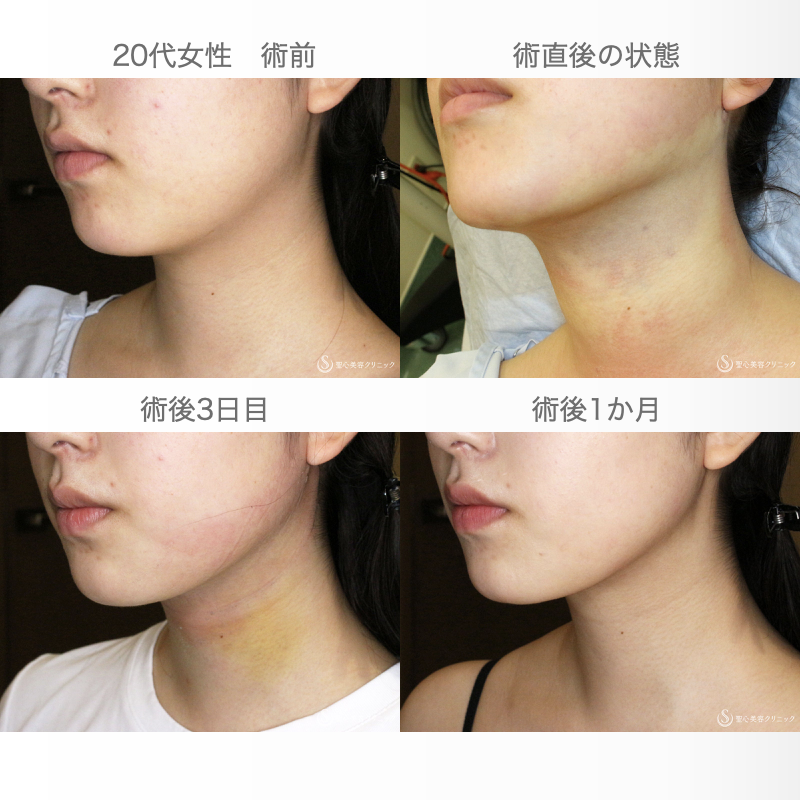 【20代女性・二重アゴ解消】ベイザー脂肪吸引（直後〜1ヶ月後） Before 