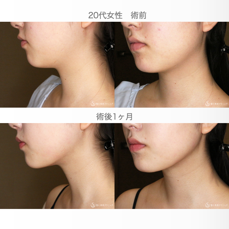 【20代女性・二重アゴ解消】ベイザー脂肪吸引（直後〜1ヶ月後） After 