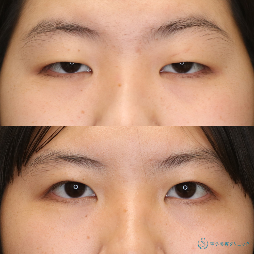 【10代女性・目の開きを改善】眼瞼下垂(切開法)（2ヶ月後） After 