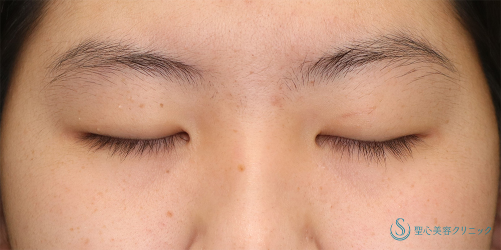 【10代女性・目の開きを改善】眼瞼下垂(切開法)（2ヶ月後） Before 
