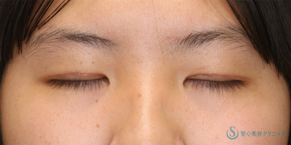 【10代女性・目の開きを改善】眼瞼下垂(切開法)（2ヶ月後） After 