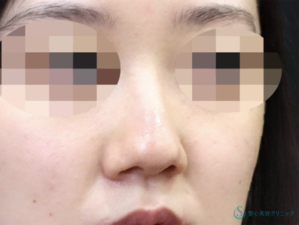 【20代女性・鼻全体をスッキリと】Gメッシュ＋鼻尖縮小＋鼻尖形成（耳介軟骨移植）＋小鼻縮小（術後1ヶ月） Before 