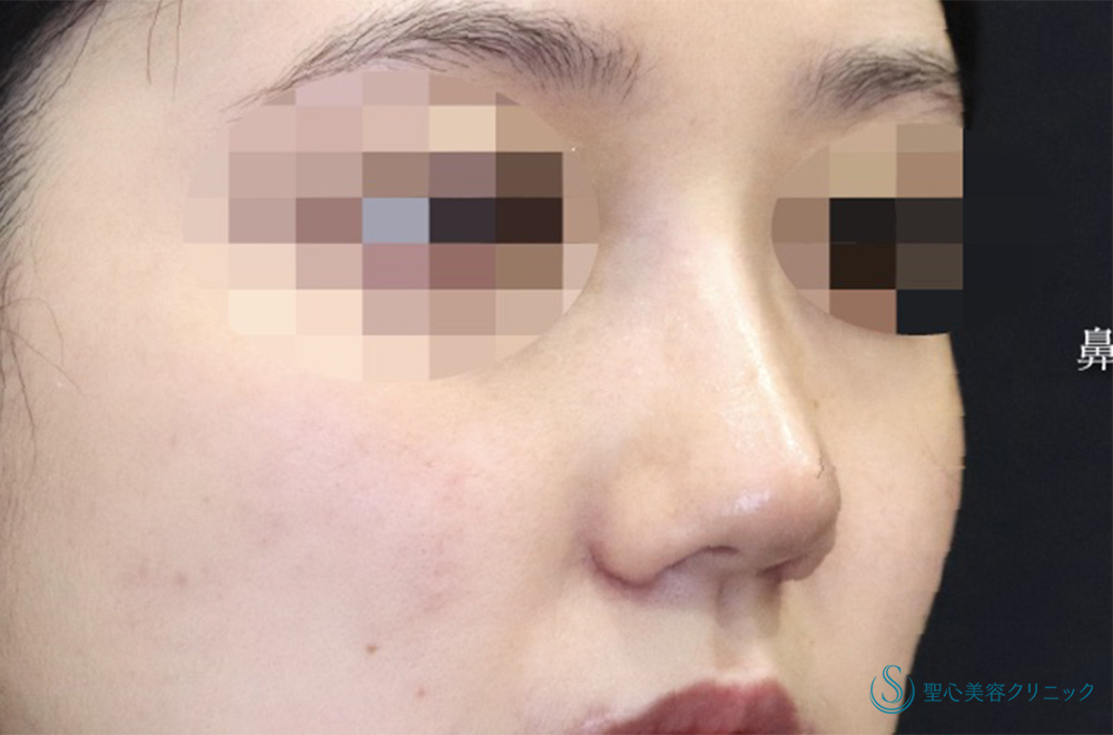【20代女性・鼻全体をスッキリと】Gメッシュ＋鼻尖縮小＋鼻尖形成（耳介軟骨移植）＋小鼻縮小（術後1ヶ月） After 