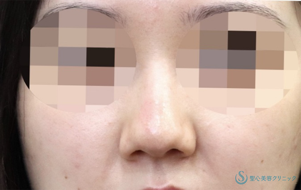 【20代女性・鼻全体をスッキリと】Gメッシュ＋鼻尖縮小＋鼻尖形成（耳介軟骨移植）＋小鼻縮小（術後1ヶ月） Before 