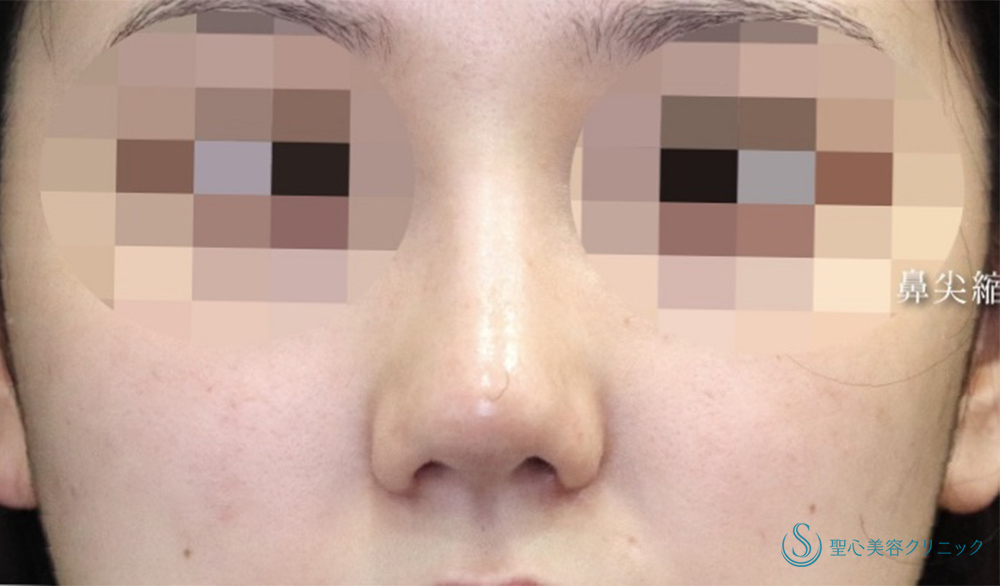 【20代女性・鼻全体をスッキリと】Gメッシュ＋鼻尖縮小＋鼻尖形成（耳介軟骨移植）＋小鼻縮小（術後1ヶ月） After 