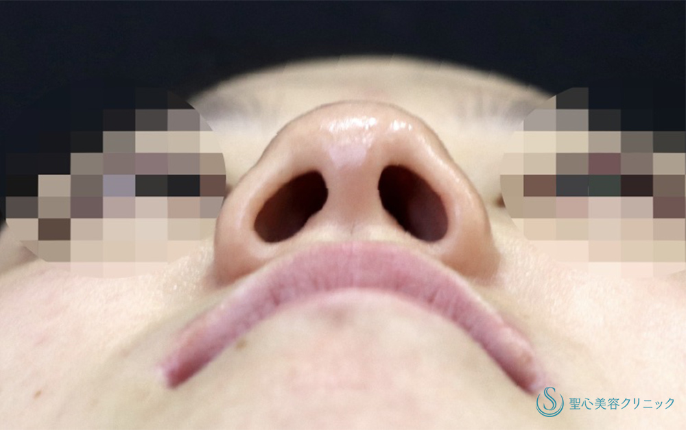 【20代女性・鼻全体をスッキリと】Gメッシュ＋鼻尖縮小＋鼻尖形成（耳介軟骨移植）＋小鼻縮小（術後1ヶ月） Before 