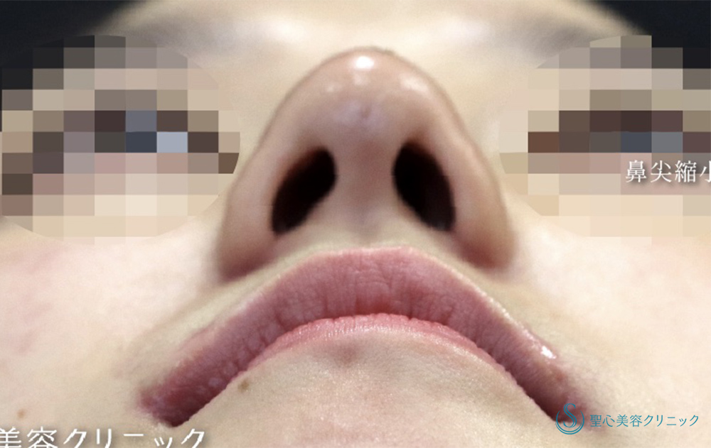 【20代女性・鼻全体をスッキリと】Gメッシュ＋鼻尖縮小＋鼻尖形成（耳介軟骨移植）＋小鼻縮小（術後1ヶ月） After 
