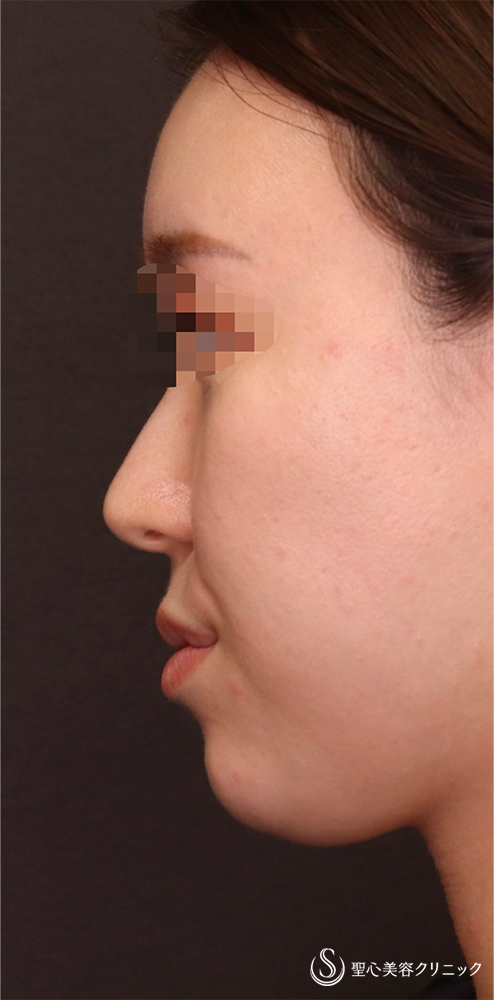 【30代女性・頬＋あご下の脂肪吸引で理想のフェイスラインに！！】脂肪吸引（術後3ヶ月） Before 
