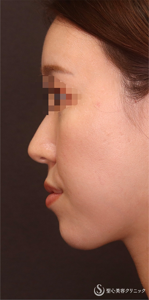 【30代女性・頬＋あご下の脂肪吸引で理想のフェイスラインに！！】脂肪吸引（術後3ヶ月） After 