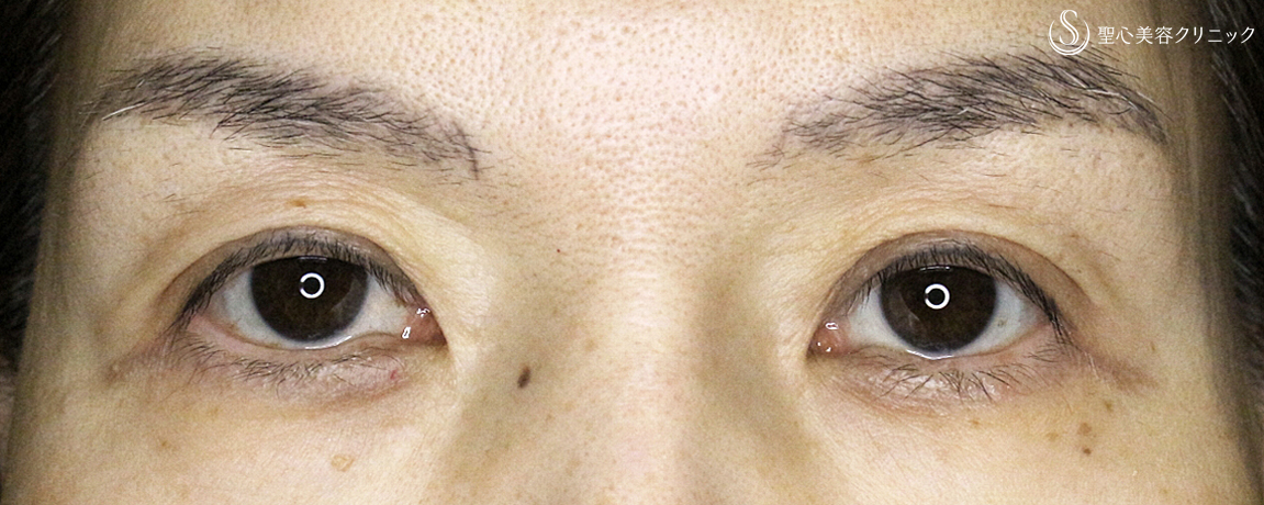 【50代女性・くぼみ目の改善効果も】「切らない眼瞼下垂+α法」単独（8年後） After 