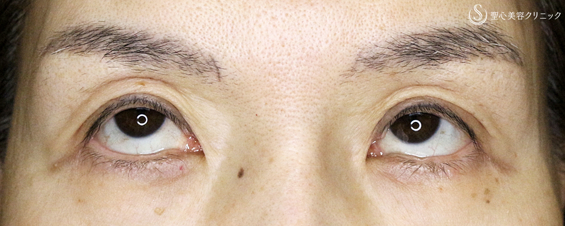 【50代女性・くぼみ目の改善効果も】「切らない眼瞼下垂+α法」単独（8年後） After 