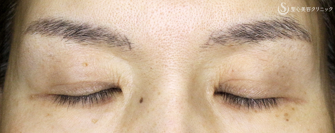 【50代女性・くぼみ目の改善効果も】「切らない眼瞼下垂+α法」単独（8年後） After 