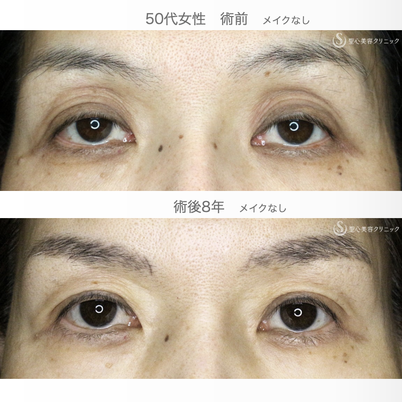 【50代女性・くぼみ目の改善効果も】「切らない眼瞼下垂+α法」単独（8年後） After 