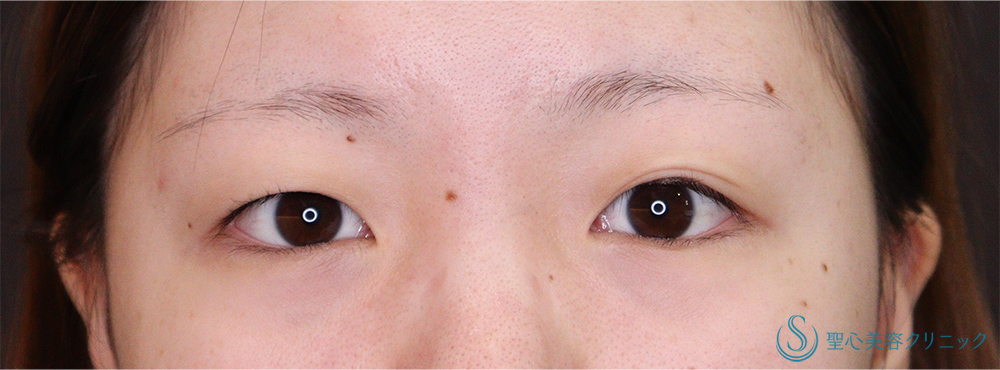 【20代女性・左右差のある二重を整えつつ、広いラインの二重に】埋没法(マイクロメソッド+α 3点)（術後1ヶ月） Before 
