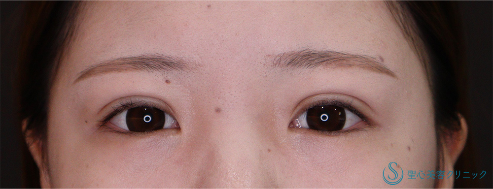 【20代女性・左右差のある二重を整えつつ、広いラインの二重に】埋没法(マイクロメソッド+α 3点)（術後1ヶ月） After 