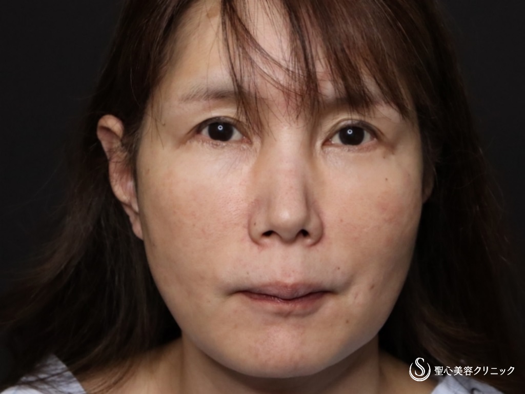 【50代女性・フェイスラインをスッキリ】フェイスリフト（リガメント処置+頬あご下脂肪吸引）（術後1か月） Before 