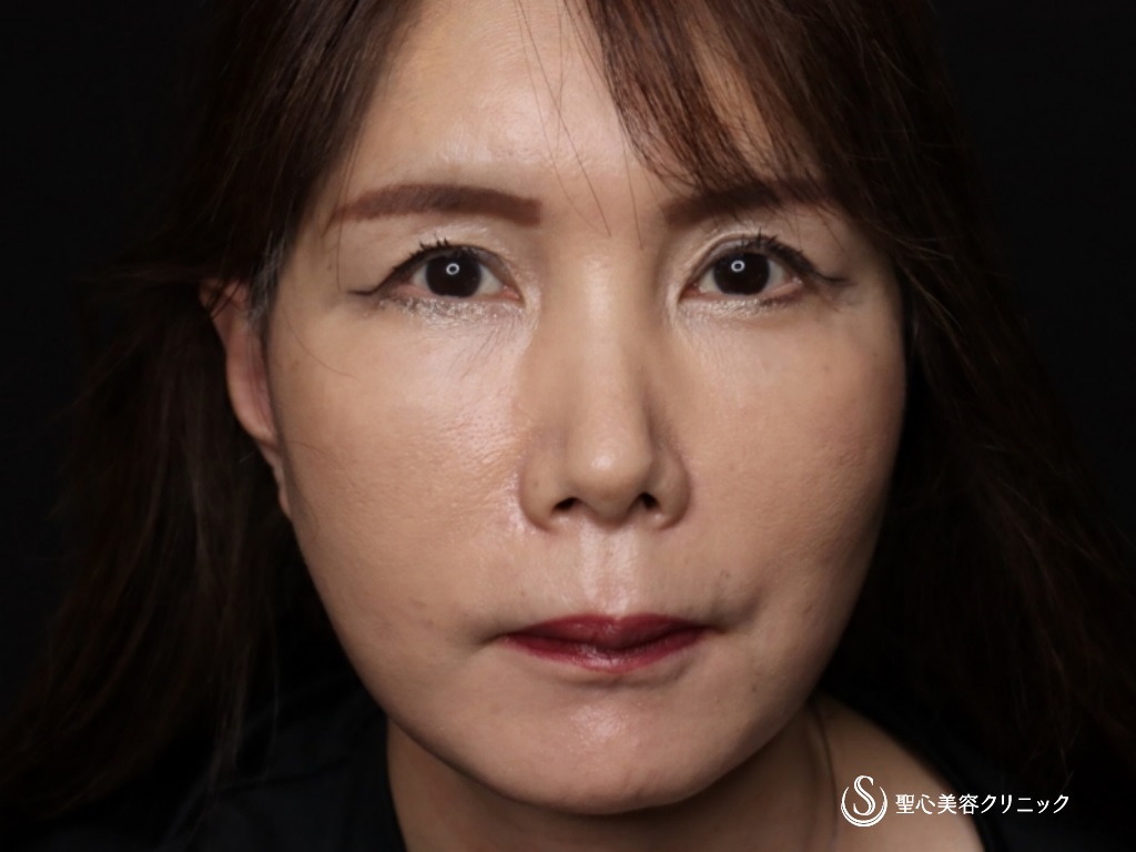 【50代女性・フェイスラインをスッキリ】フェイスリフト（リガメント処置+頬あご下脂肪吸引）（術後1か月） After 