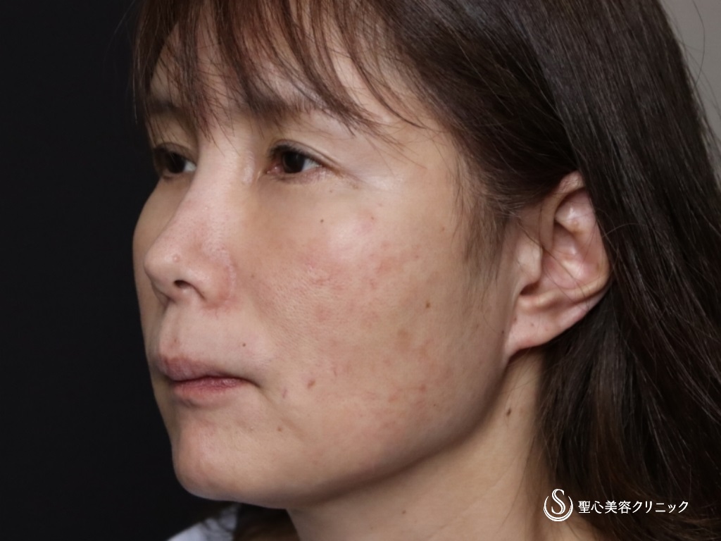 【50代女性・フェイスラインをスッキリ】フェイスリフト（リガメント処置+頬あご下脂肪吸引）（術後1か月） Before 