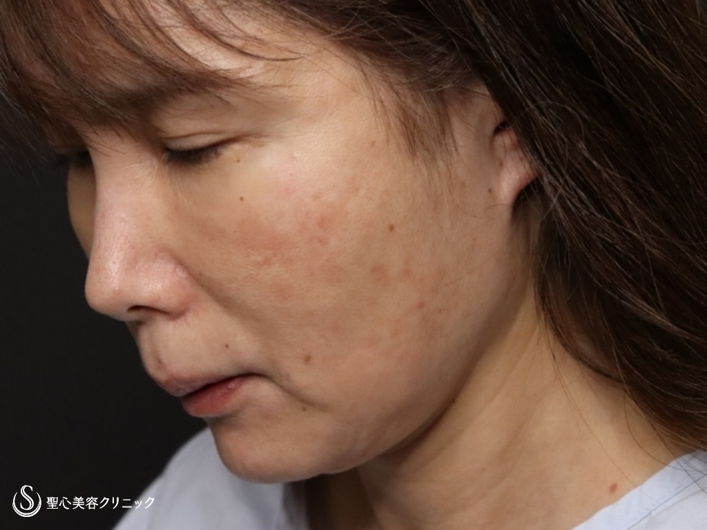 【50代女性・フェイスラインをスッキリ】フェイスリフト（リガメント処置+頬あご下脂肪吸引）（術後1か月） Before 