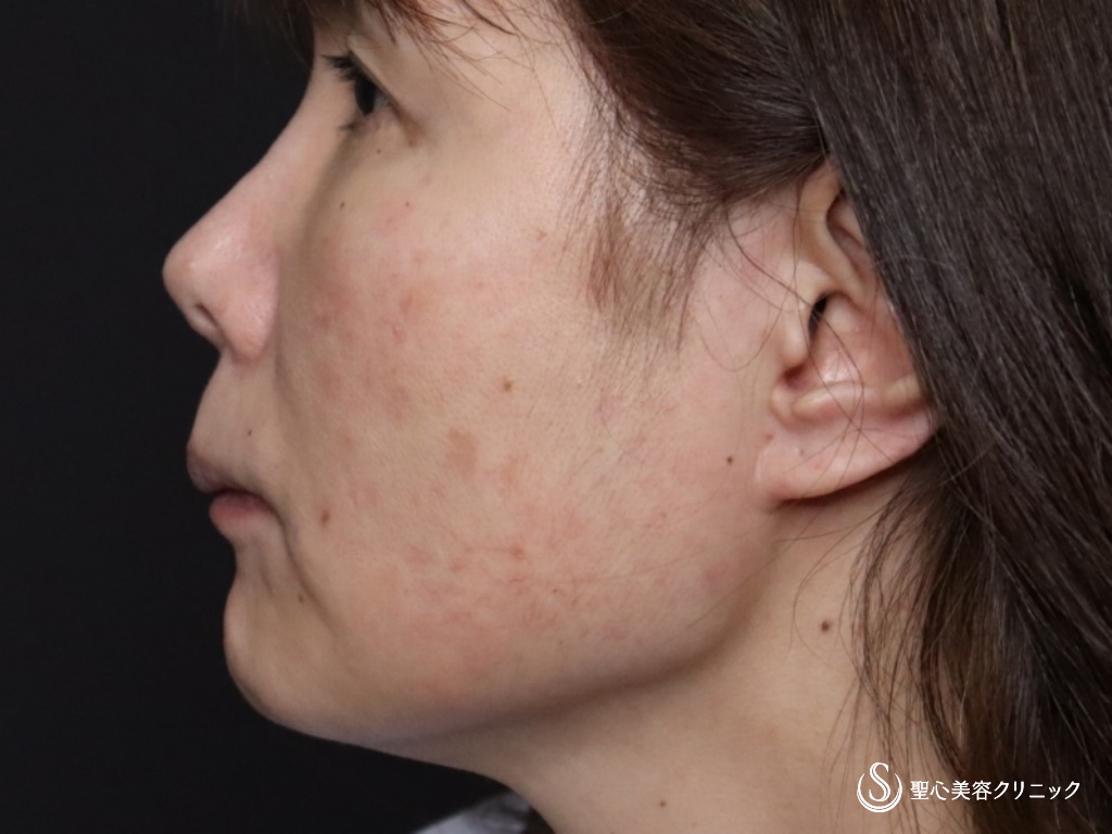 【50代女性・フェイスラインをスッキリ】フェイスリフト（リガメント処置+頬あご下脂肪吸引）（術後1か月） Before 