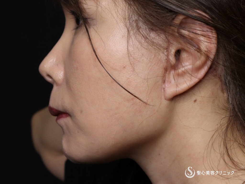 【50代女性・フェイスラインをスッキリ】フェイスリフト（リガメント処置+頬あご下脂肪吸引）（術後1か月） After 