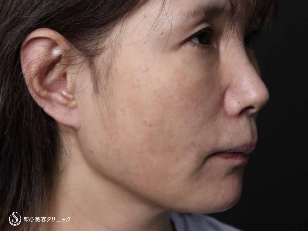【50代女性・フェイスラインをスッキリ】フェイスリフト（リガメント処置+頬あご下脂肪吸引）（術後1か月） Before 