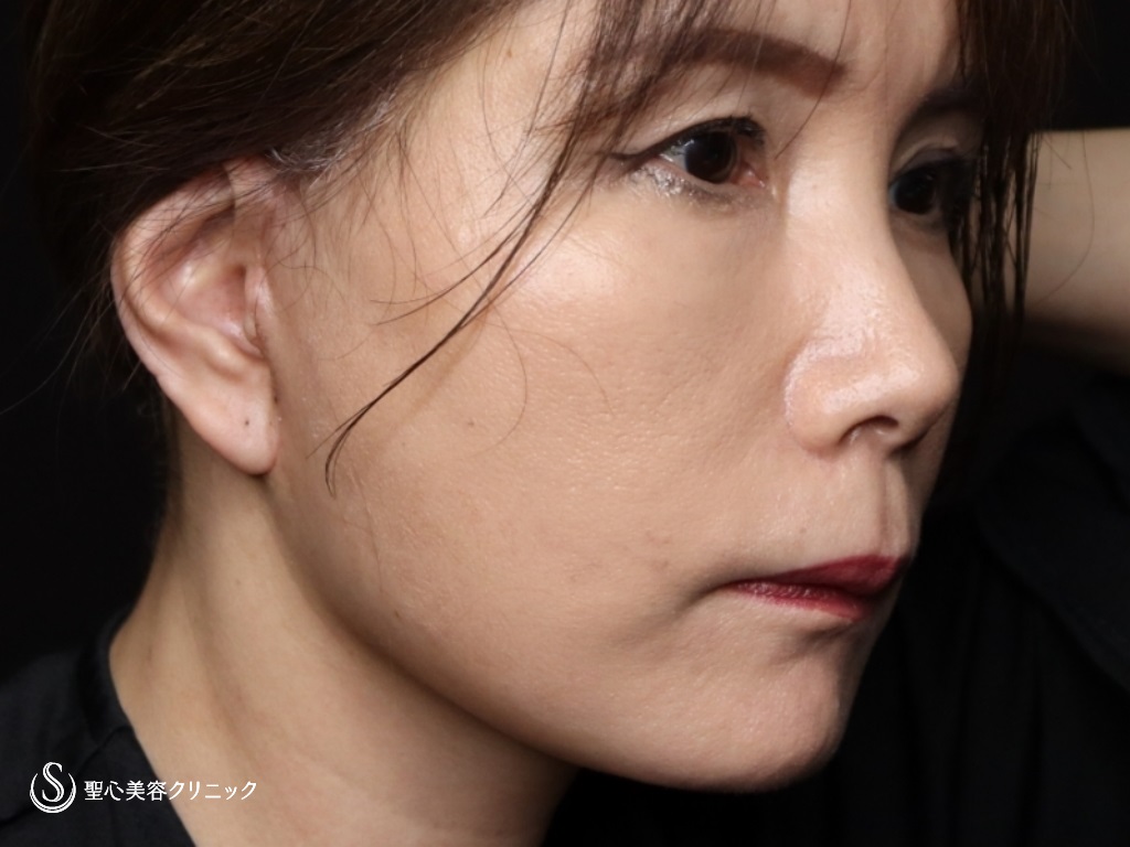 【50代女性・フェイスラインをスッキリ】フェイスリフト（リガメント処置+頬あご下脂肪吸引）（術後1か月） After 