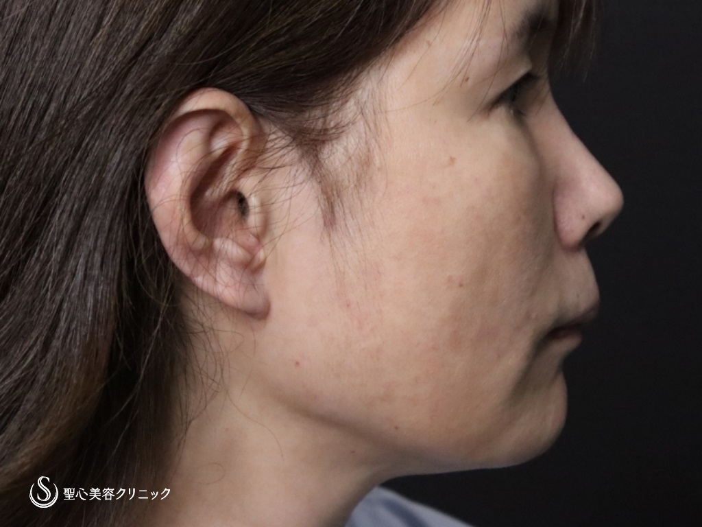 【50代女性・フェイスラインをスッキリ】フェイスリフト（リガメント処置+頬あご下脂肪吸引）（術後1か月） Before 