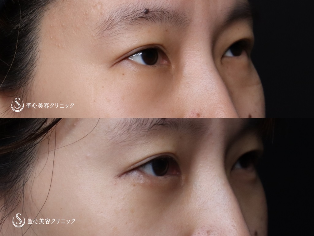 【30代女性・目元の印象を若々しく】目の下の脱脂＋グラマラスライン形成（切開法）（術後1ヶ月） After 