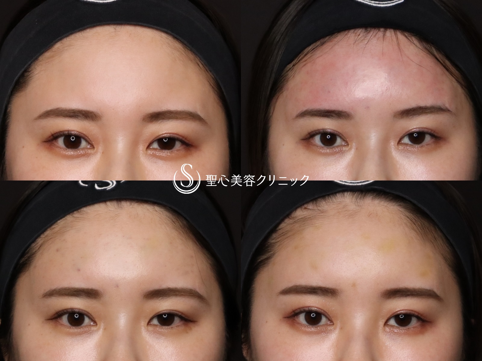 【20代女性・額をふっくらと】プレミアムPRP皮膚再生療法（処置後1か月） After 