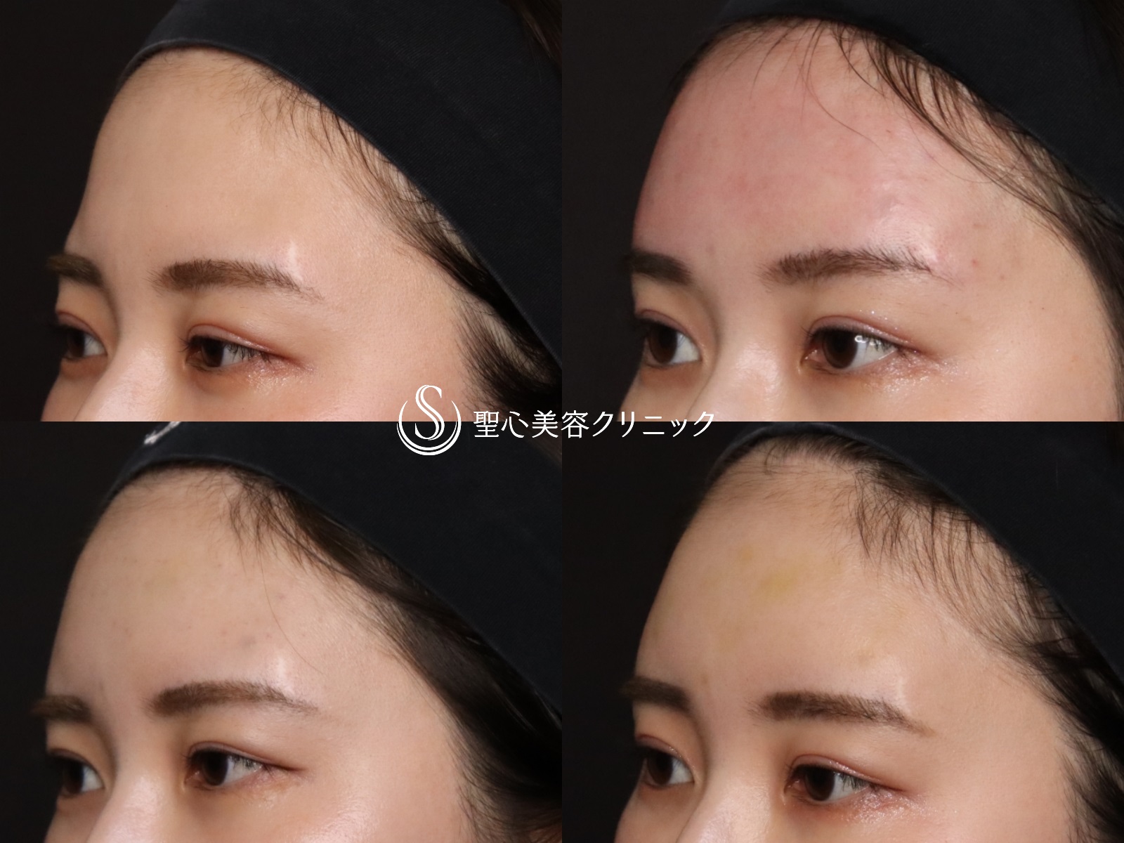 【20代女性・額をふっくらと】プレミアムPRP皮膚再生療法（処置後1か月） After 