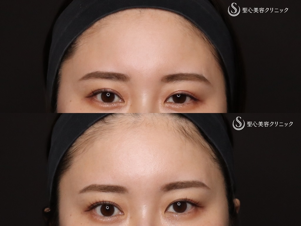 【20代女性・額をふっくらと】プレミアムPRP皮膚再生療法（処置後1か月） Before 
